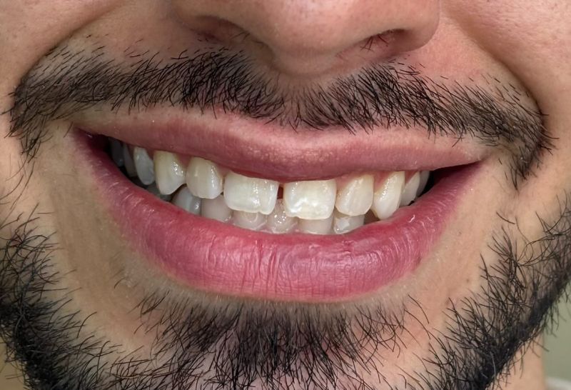 Antes — Diseño de sonrisa 1