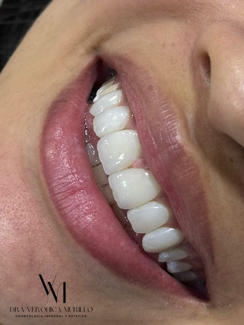 Después — Diseño de sonrisa 2