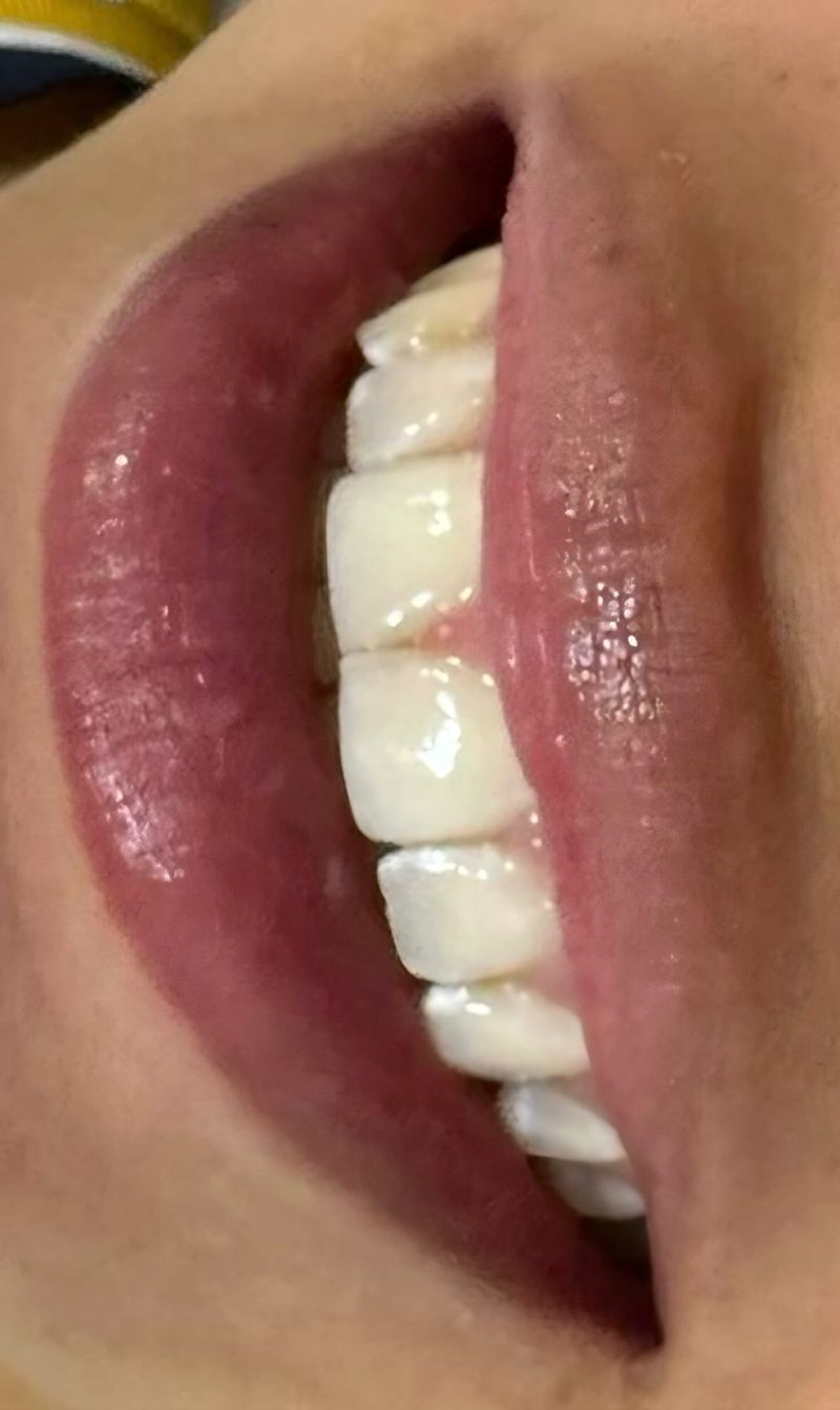 Antes — Diseño de sonrisa 2