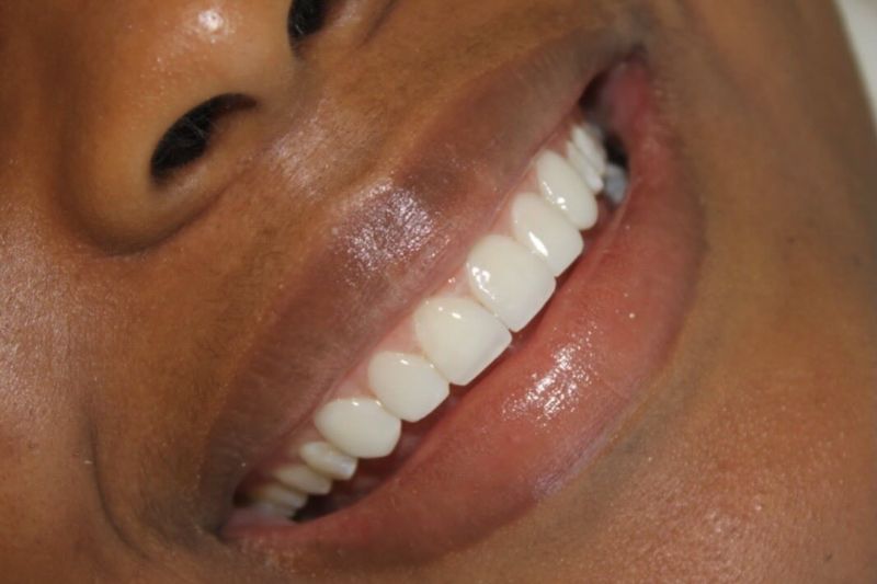 Después — Diseño de sonrisa 4