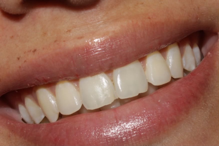 Antes — Diseño de sonrisa 5