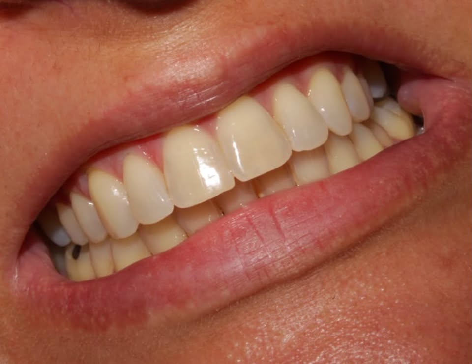 Antes — Diseño de sonrisa 6